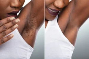 Everything You Need to Know About Laser Hair Removal for Dark Skin